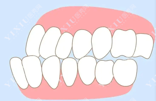 牙齿地包天的图片