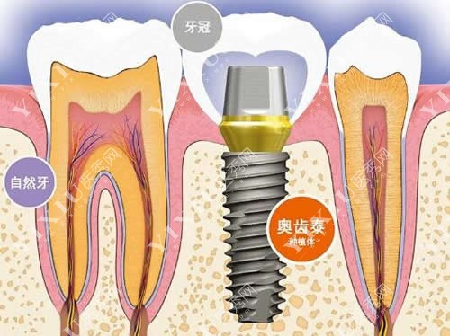 韩国奥齿泰种植体卡通图