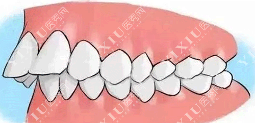 牙齿龅牙的图片