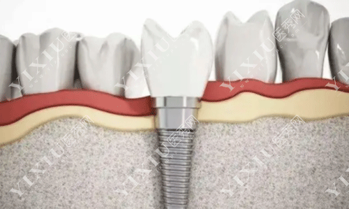 牙齿种植体图片