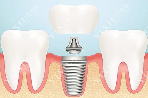 种植牙示意图