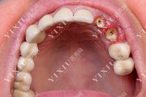 牙齿龋坏钻洞图