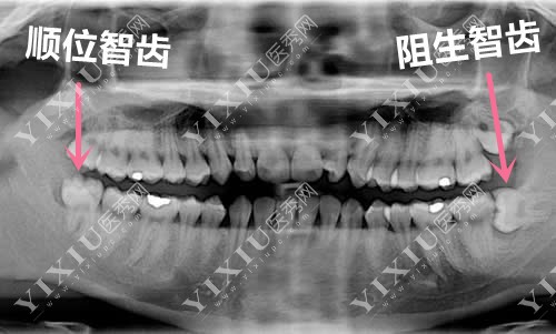 正位智齿和阻生智齿对比