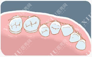 牙齿矫正漫画图