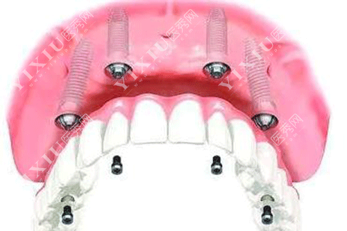 牙齿多颗种植的图片