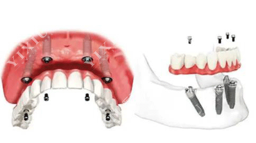 牙齿全口多颗种植的图片