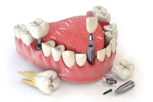 种植牙模型图