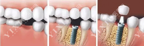 牙齿缺牙种植的过程图片