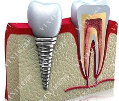 牙齿锥形种植牙的图片