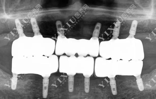 牙齿全口ALL-ON-6种植图片