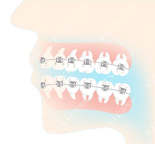 牙齿矫正侧位透视图