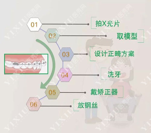 牙齿矫正过程