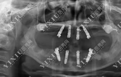 牙齿全口全固定种植的图片