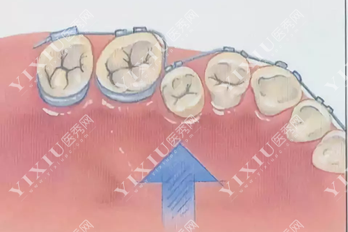 牙齿矫正示意图