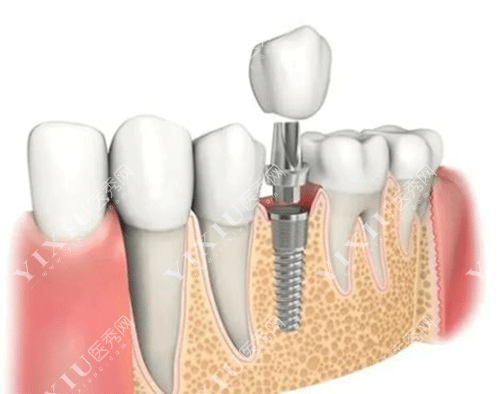 牙齿种牙稳固耐用图片