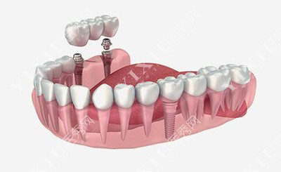 种植牙修复改善治疗展示图