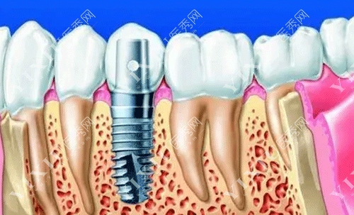 牙齿种植牙五级钛材质的图片