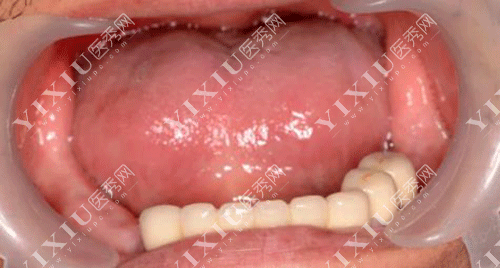 移植牙齿和种植牙齿哪个好?自体牙移植比种植牙便宜吗?(图8) 移植牙齿和种植牙齿哪个好?自体牙移植比种植牙便宜吗?(图8)