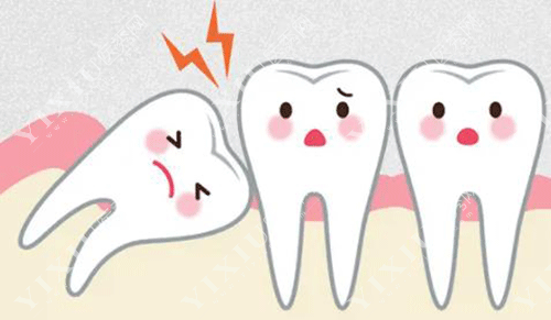 移植牙齿和种植牙齿哪个好?自体牙移植比种植牙便宜吗?(图4) 移植牙齿和种植牙齿哪个好?自体牙移植比种植牙便宜吗?(图4)