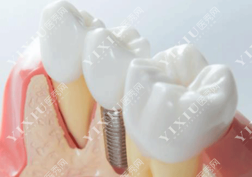 移植牙齿和种植牙齿哪个好?自体牙移植比种植牙便宜吗?(图7) 移植牙齿和种植牙齿哪个好?自体牙移植比种植牙便宜吗?(图7)