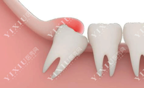 移植牙齿和种植牙齿哪个好?自体牙移植比种植牙便宜吗?(图1) 移植牙齿和种植牙齿哪个好?自体牙移植比种植牙便宜吗?(图1)