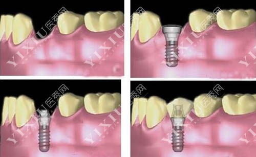 种植牙过程示意图