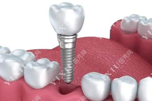 移植牙齿和种植牙齿哪个好?自体牙移植比种植牙便宜吗?(图10) 移植牙齿和种植牙齿哪个好?自体牙移植比种植牙便宜吗?(图10)