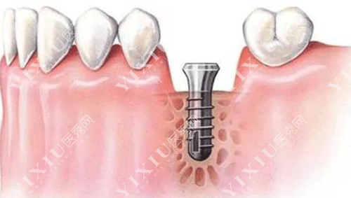 移植牙齿和种植牙齿哪个好?自体牙移植比种植牙便宜吗?(图6) 移植牙齿和种植牙齿哪个好?自体牙移植比种植牙便宜吗?(图6)