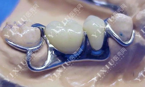 牙缺失活动义齿修复展示