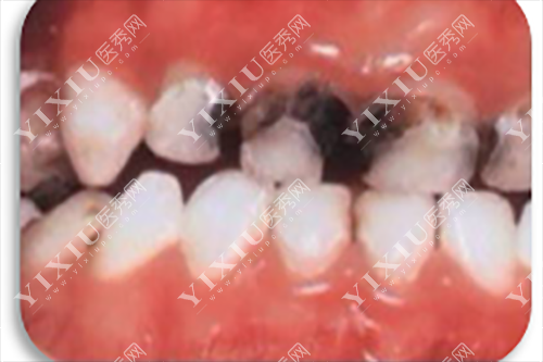 牙齿根部龋坏图片