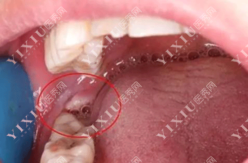 移植牙齿和种植牙齿哪个好?自体牙移植比种植牙便宜吗?(图2) 移植牙齿和种植牙齿哪个好?自体牙移植比种植牙便宜吗?(图2)