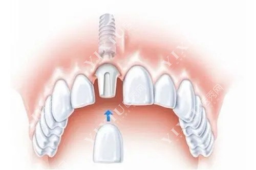 全瓷冠种植牙示意图