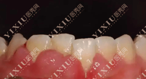 做了种植牙我不想活了?2980元做的种植牙脸肿了好几天 做完种植牙好后悔!(图1) 做了种植牙我不想活了?2980元做的种植牙脸肿了好几天 做完种植牙好后悔!(图1)