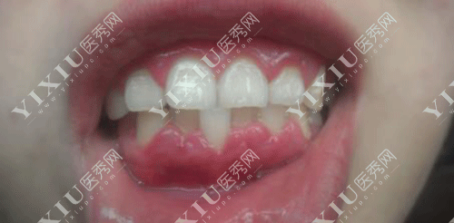 做了种植牙我不想活了?2980元做的种植牙脸肿了好几天 做完种植牙好后悔!(图5) 做了种植牙我不想活了?2980元做的种植牙脸肿了好几天 做完种植牙好后悔!(图5)