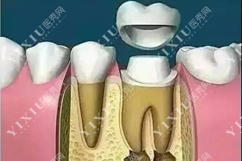 牙冠示意图