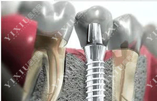 做了种植牙我不想活了?2980元做的种植牙脸肿了好几天 做完种植牙好后悔!(图4) 做了种植牙我不想活了?2980元做的种植牙脸肿了好几天 做完种植牙好后悔!(图4)