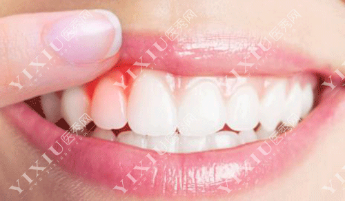 做了种植牙我不想活了?2980元做的种植牙脸肿了好几天 做完种植牙好后悔!(图3) 做了种植牙我不想活了?2980元做的种植牙脸肿了好几天 做完种植牙好后悔!(图3)