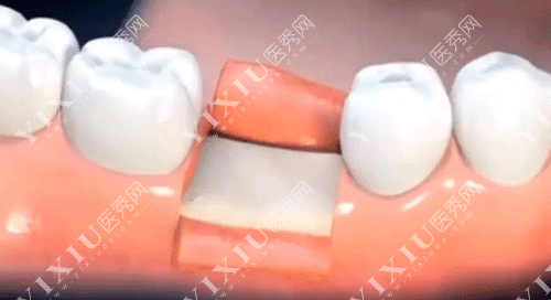 做了种植牙我不想活了?2980元做的种植牙脸肿了好几天 做完种植牙好后悔!(图9) 做了种植牙我不想活了?2980元做的种植牙脸肿了好几天 做完种植牙好后悔!(图9)