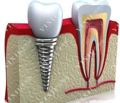 做了种植牙我不想活了?2980元做的种植牙脸肿了好几天 做完种植牙好后悔!(图7) 做了种植牙我不想活了?2980元做的种植牙脸肿了好几天 做完种植牙好后悔!(图7)