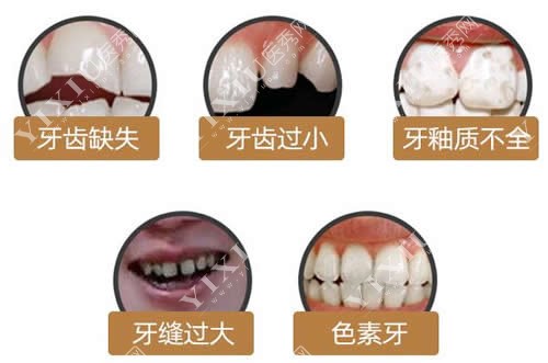 牙贴面改善问题分析