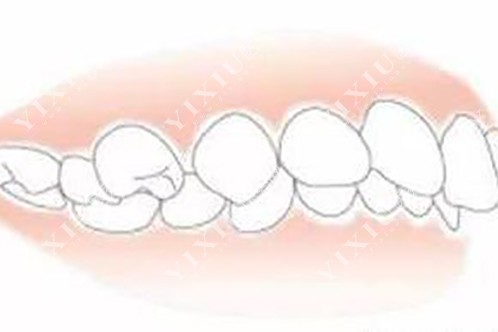 牙列不齐示意图