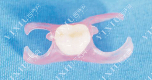 隐形义齿适合年轻人吗 ?看了隐形义齿优缺点及使用期限就秒懂了!(图3) 隐形义齿适合年轻人吗 ?看了隐形义齿优缺点及使用期限就秒懂了!(图3)