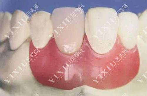 隐形义齿适合年轻人吗 ?看了隐形义齿优缺点及使用期限就秒懂了!(图5) 隐形义齿适合年轻人吗 ?看了隐形义齿优缺点及使用期限就秒懂了!(图5)