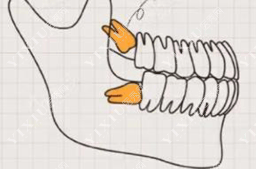 两颗智齿需要拔牙图片