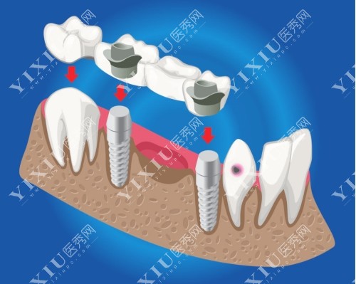 种植牙连桥冠