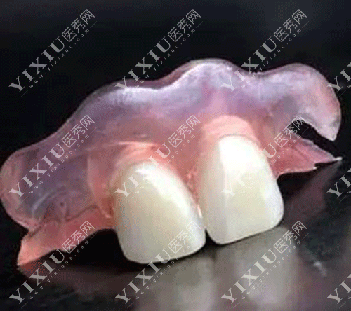 隐形义齿适合年轻人吗 ?看了隐形义齿优缺点及使用期限就秒懂了!(图1) 隐形义齿适合年轻人吗 ?看了隐形义齿优缺点及使用期限就秒懂了!(图1)