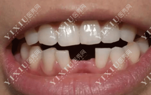 隐形义齿适合年轻人吗 ?看了隐形义齿优缺点及使用期限就秒懂了!(图2) 隐形义齿适合年轻人吗 ?看了隐形义齿优缺点及使用期限就秒懂了!(图2)