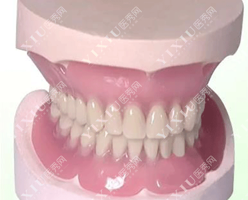 隐形义齿适合年轻人吗 ?看了隐形义齿优缺点及使用期限就秒懂了!(图8) 隐形义齿适合年轻人吗 ?看了隐形义齿优缺点及使用期限就秒懂了!(图8)