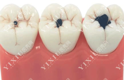 牙齿蛀牙程度的图片