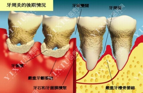 牙周炎后期情况图